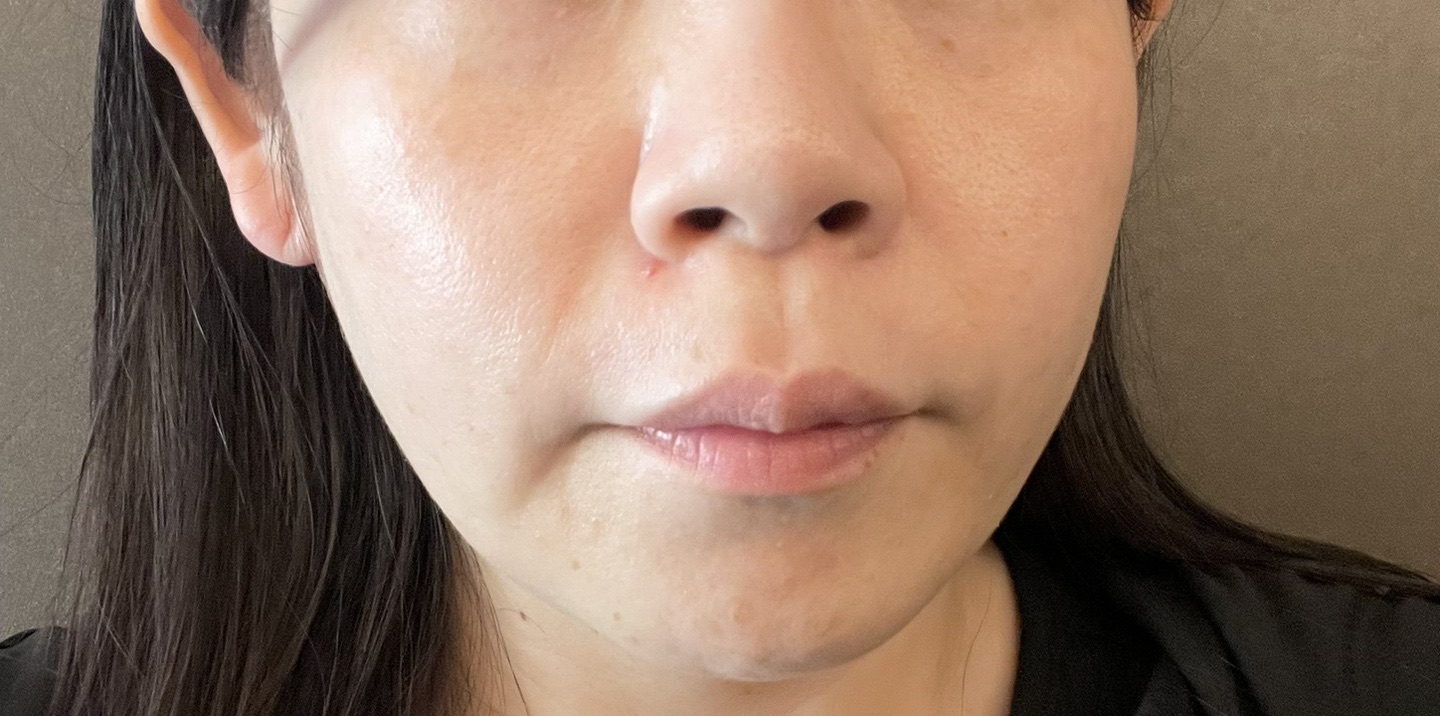 医療版5世代ピーリング！ララピール〈ララドクター〉 | SELECT CLINIC