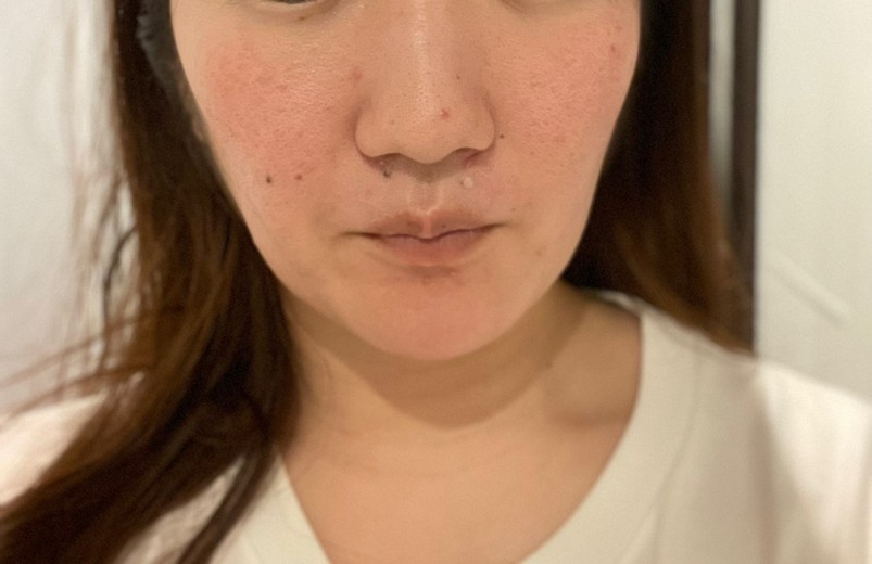 after photo: IPL(光/フォト治療)