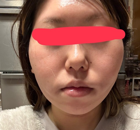 after photo: 糸リフト, 脂肪吸引(顎下), 脂肪吸引(顔), 脂肪吸引(頬)