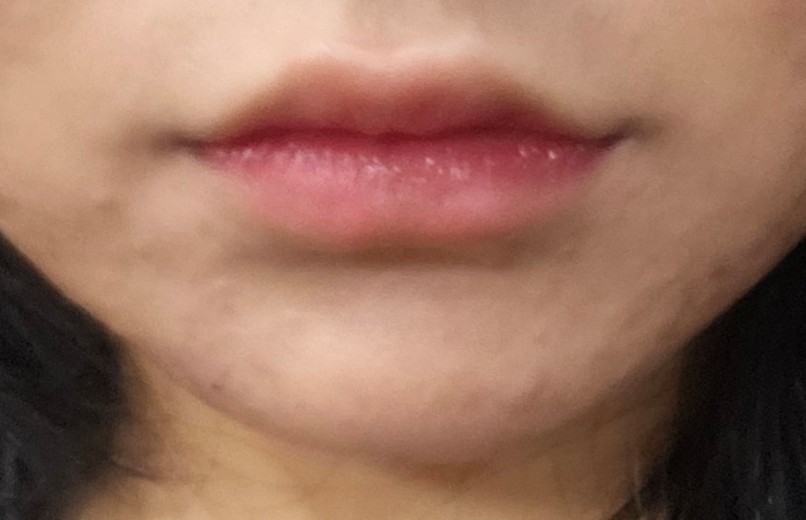 after photo: 입술필러