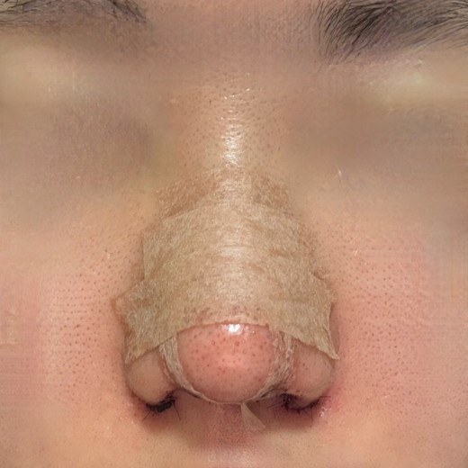 after photo: 콧볼축소, 복코교정(수술)