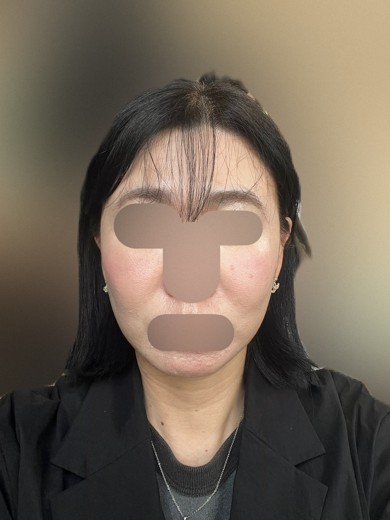 before photo: フラクショナルレーザー