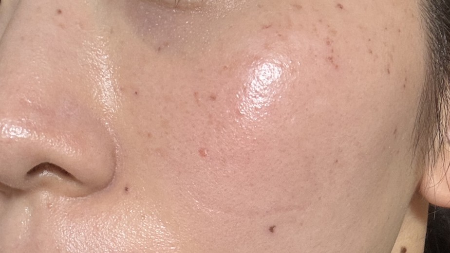after photo: IPL(光/フォト治療)
