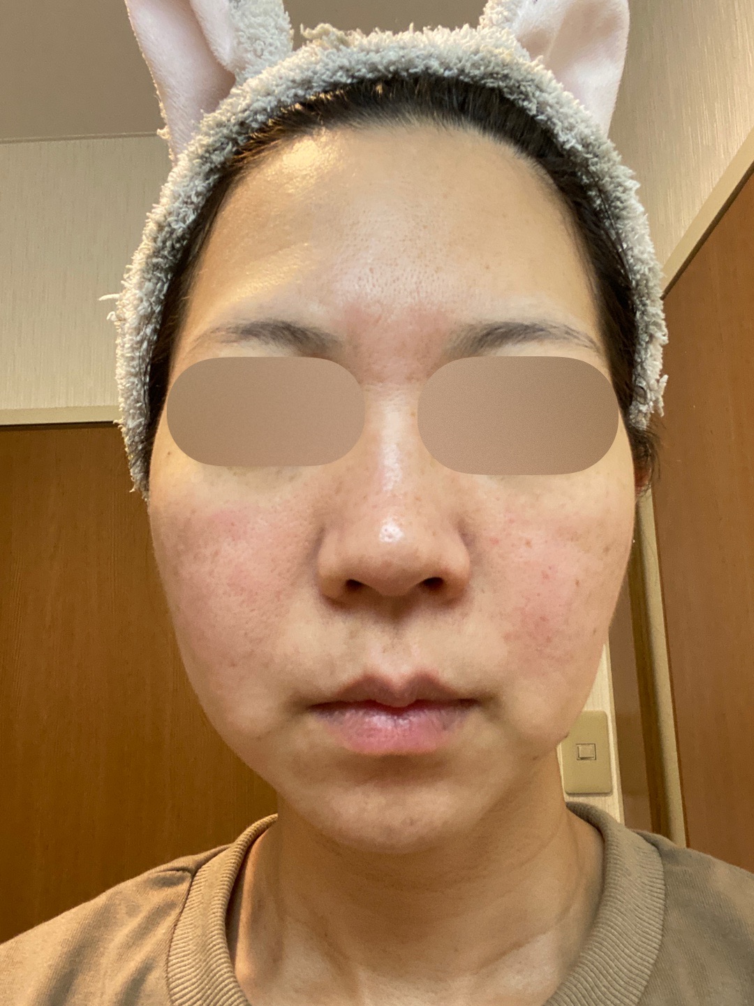 何度でも可】全顔シミ取り放題＋美顔レーザートーニング | ZX-CLINIC