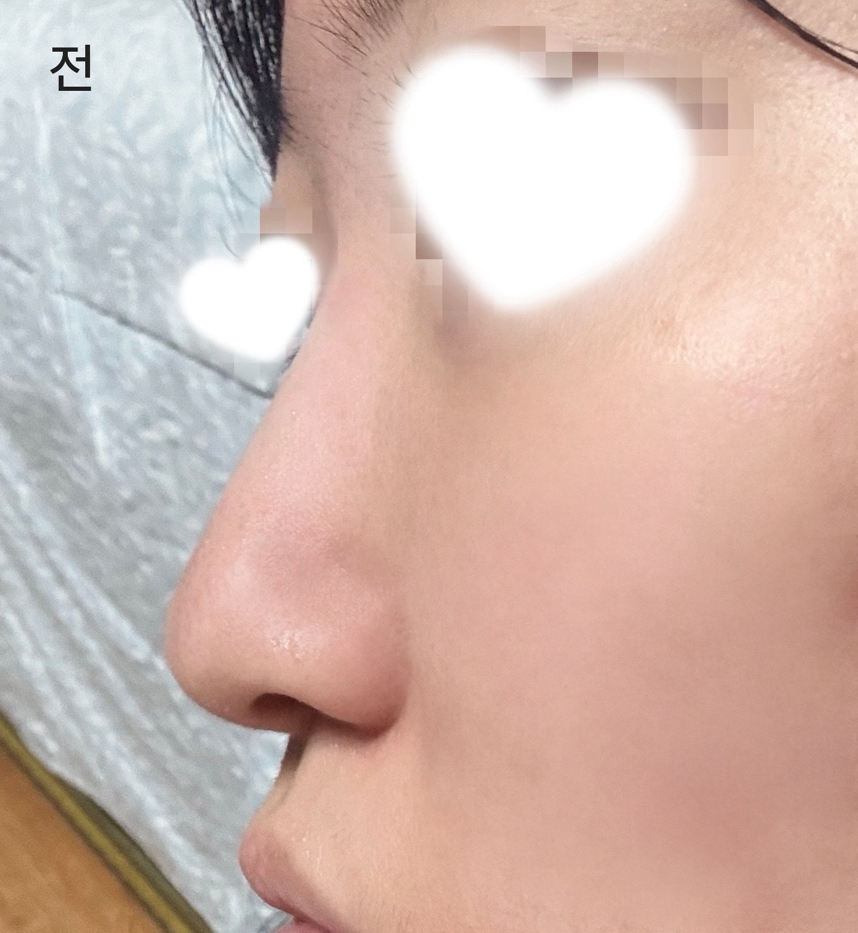 시술 전