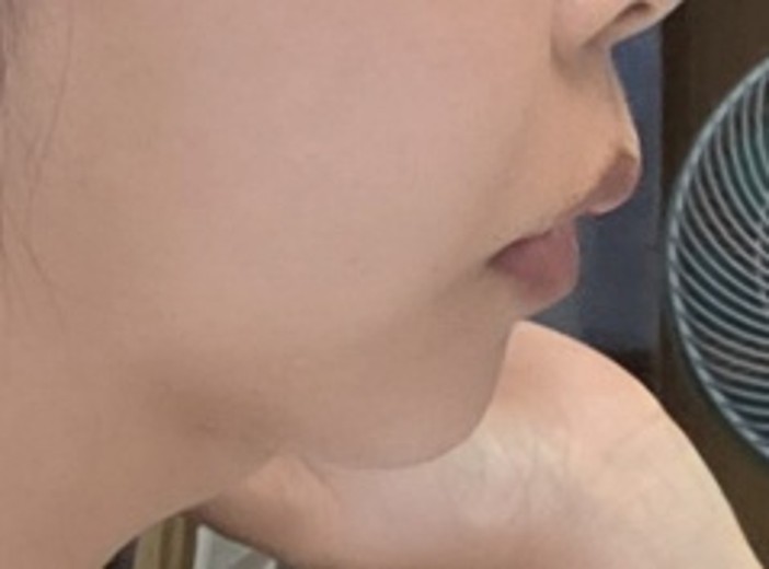 before photo: 입술필러