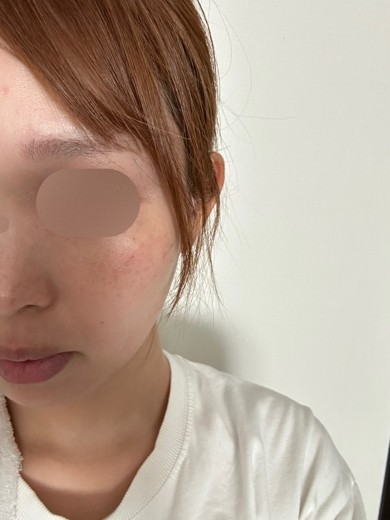 after photo: スキンボトックス