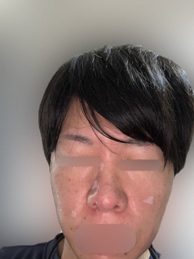 before photo: ダーマペン