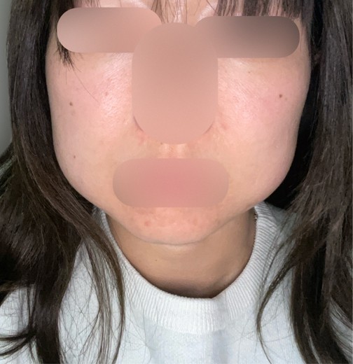 after photo: 脂肪溶解注射(顔)
