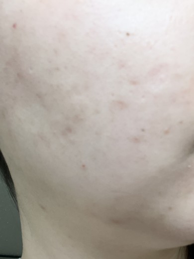 before photo: ダーマペン