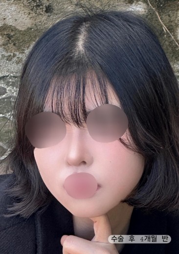 after photo: 콧대(자가조직), 코끝(자가연골)