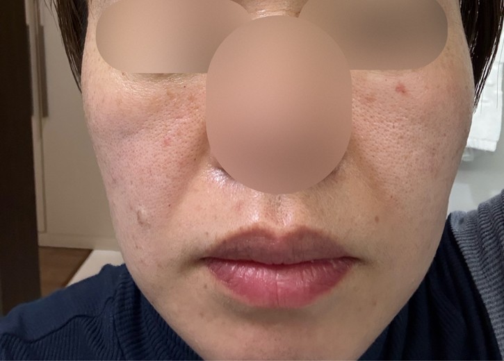 before photo: 糸リフト