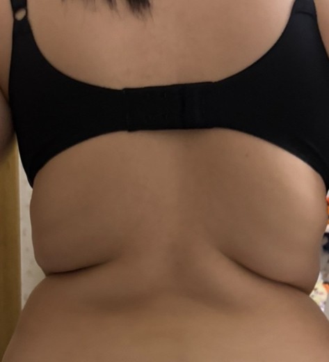 after photo: 脂肪冷却(腕)
