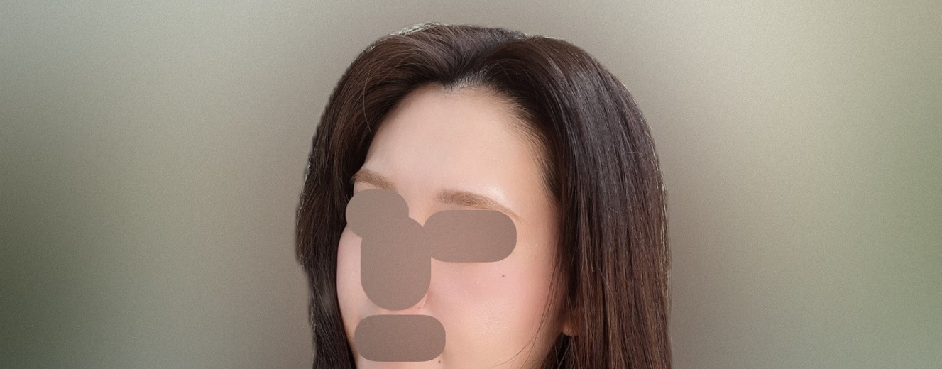 after photo: 額のしわボトックス