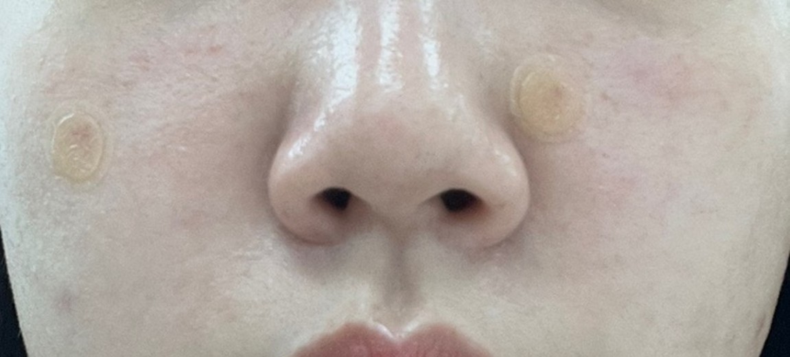 after photo: CO2레이저, 비립종제거, 사마귀제거