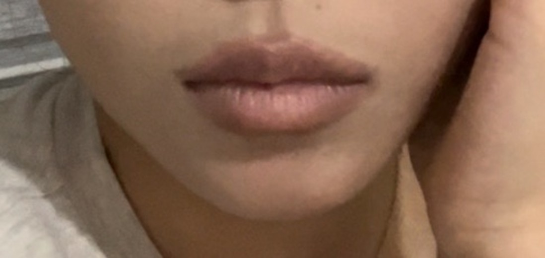 after photo: 턱필러