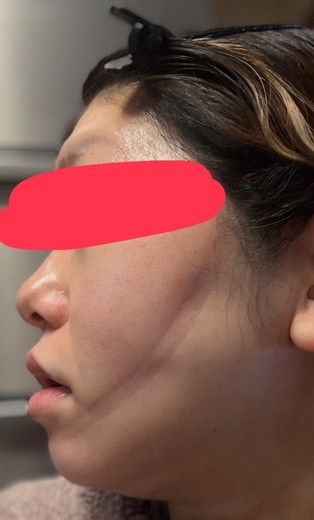 after photo: 糸リフト, 脂肪吸引(顎下), 脂肪吸引(顔), 脂肪吸引(頬)