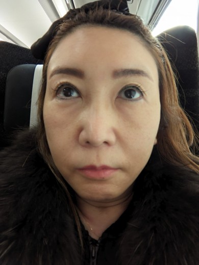 after photo: ピーリング