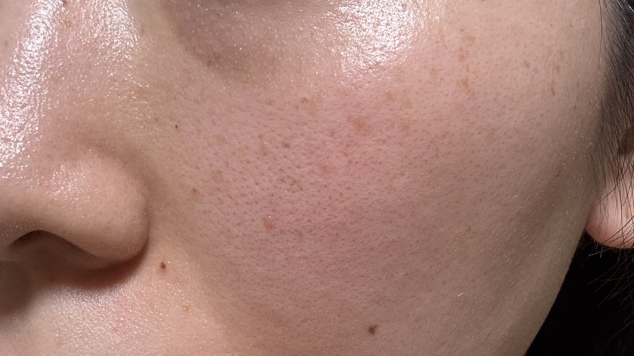 before photo: IPL(光/フォト治療)