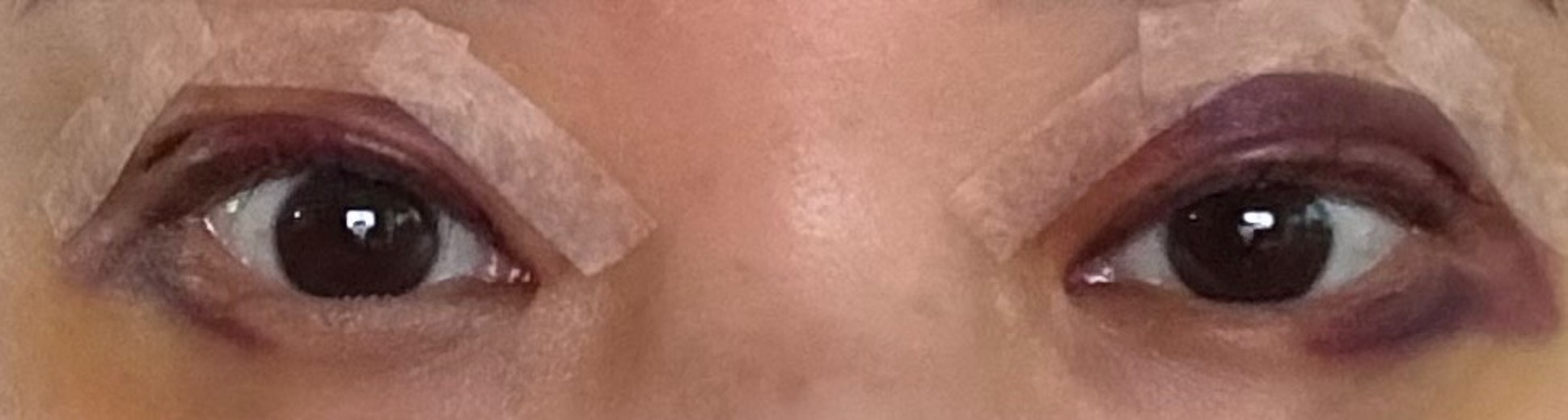 after photo: 눈재수술, 눈매교정