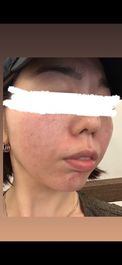 after photo: リジュランスキンブースター