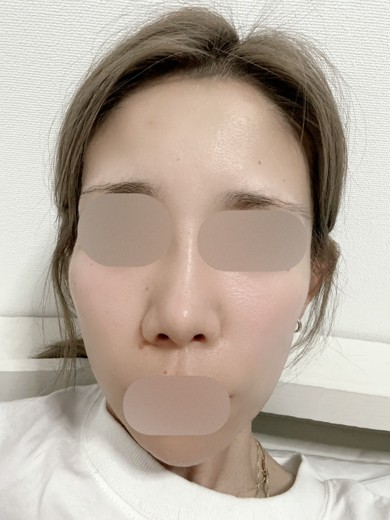 after photo: 涙袋ヒアルロン酸, 鼻ヒアルロン酸