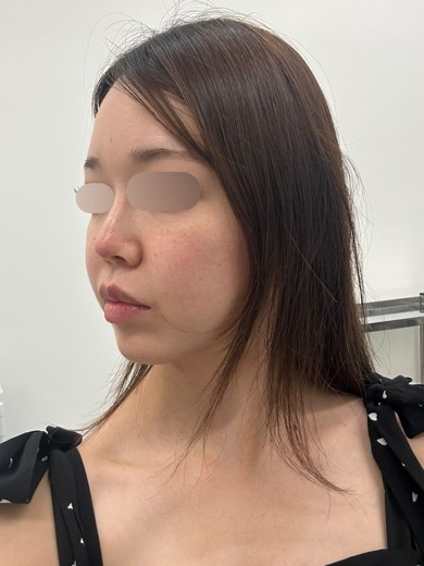 after photo: IPL(光/フォト治療)