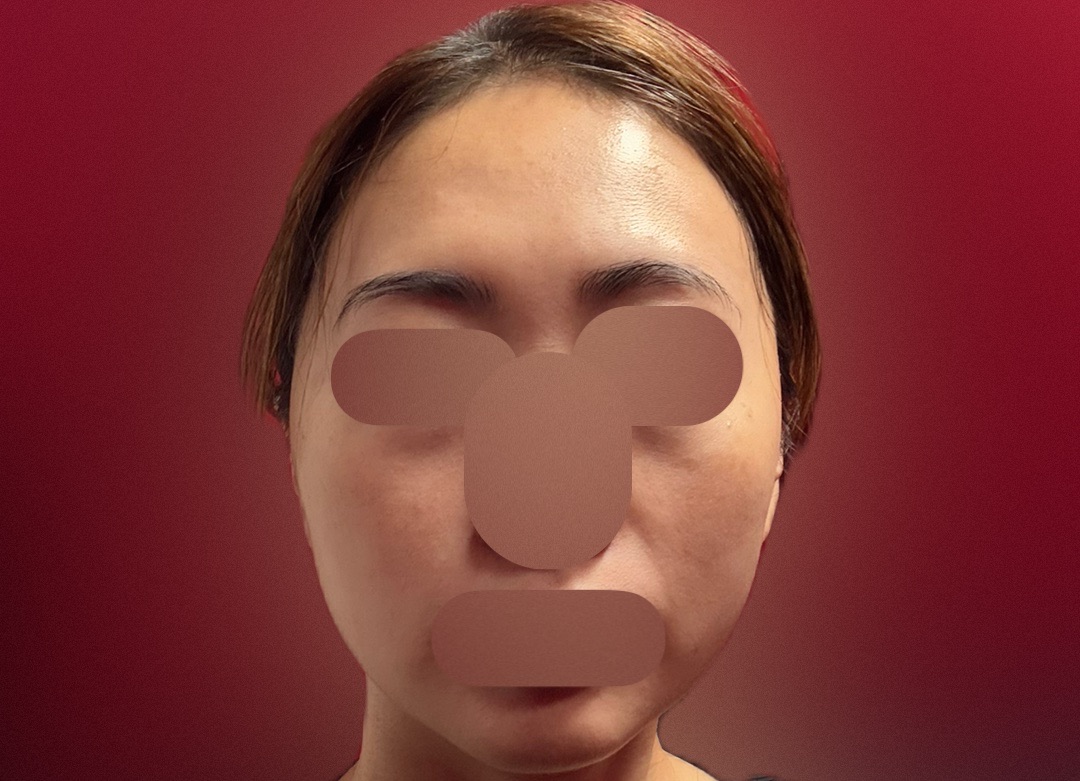 ピコトーニング＋イオン導入（ビタミンC or トラネキサム酸） | MK