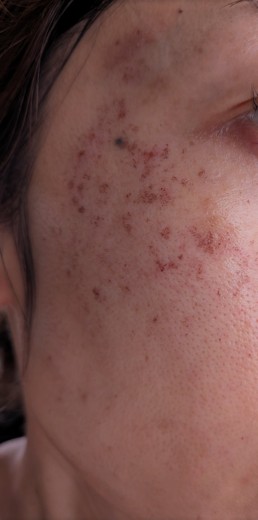 after photo: IPL(光/フォト治療), ルメッカ