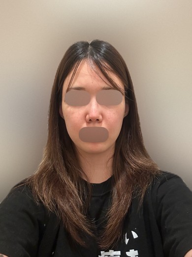 after photo: IPL(光/フォト治療)