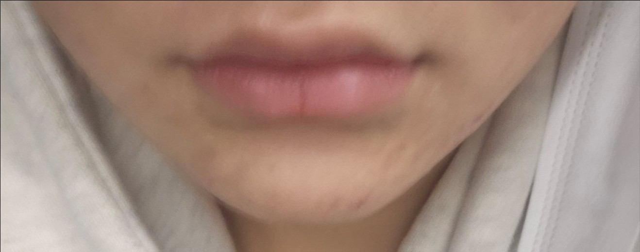 after photo: 입술필러