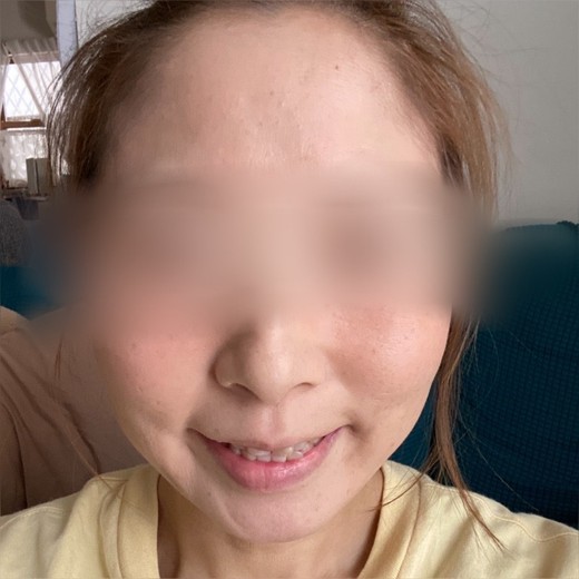 after photo: 脂肪溶解注射(顔)