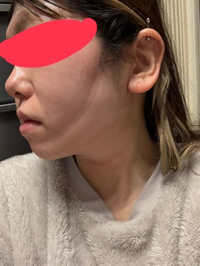 after photo: 糸リフト, 脂肪吸引(顎下), 脂肪吸引(顔), 脂肪吸引(頬)