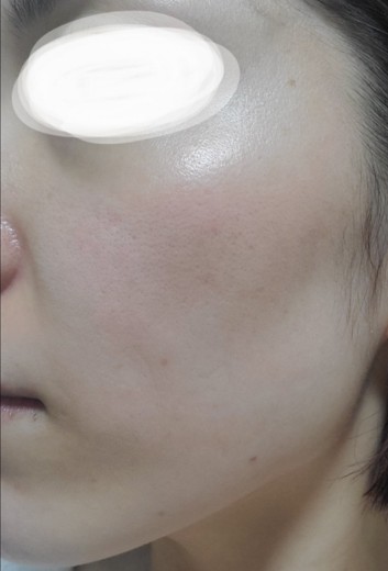 再来OK】ハイドラフェイシャル＋エレクトロポレーション | おおかみ