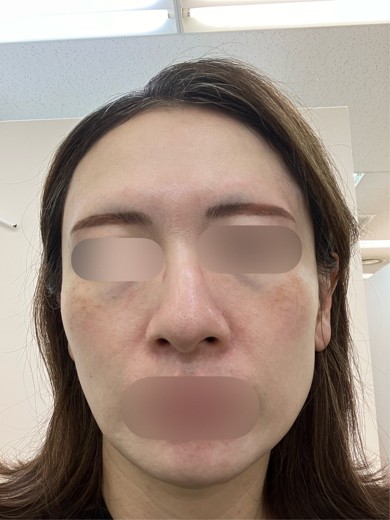 after photo: イオン導入