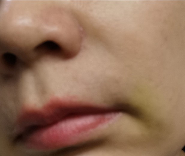 after photo: 脂肪溶解注射(顔)