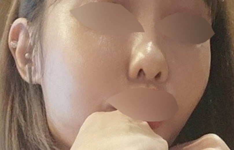 after photo: 스킨보톡스