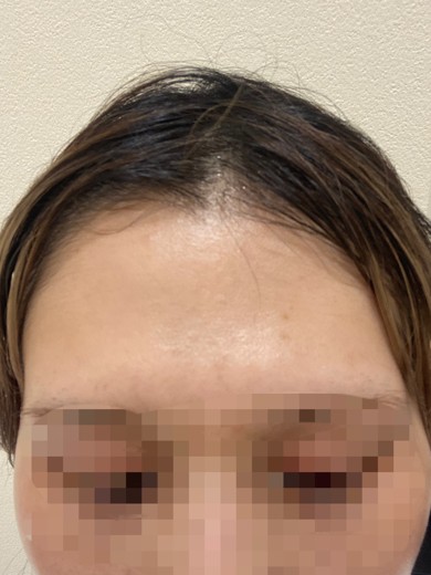 before photo: IPL(光/フォト治療), ピーリング