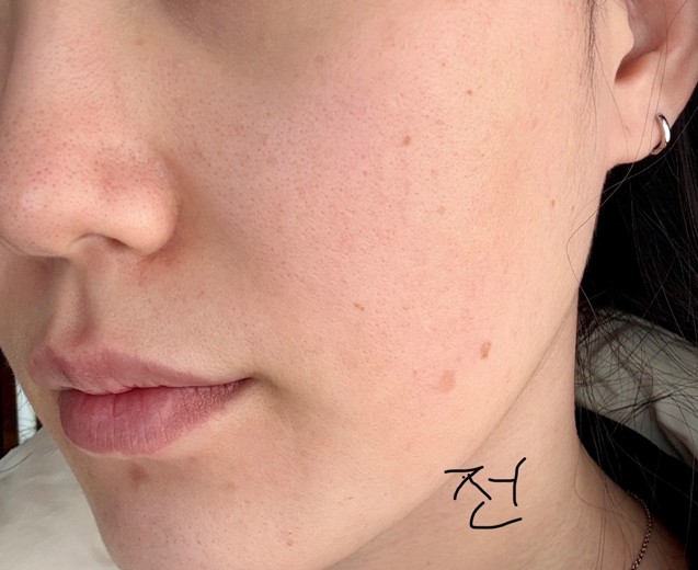 before photo: 리쥬란힐러