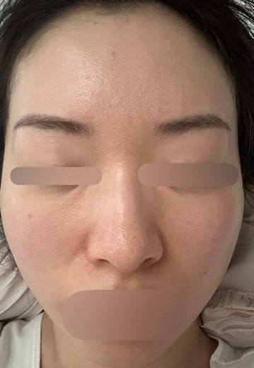 after photo: ハイドラフェイシャル