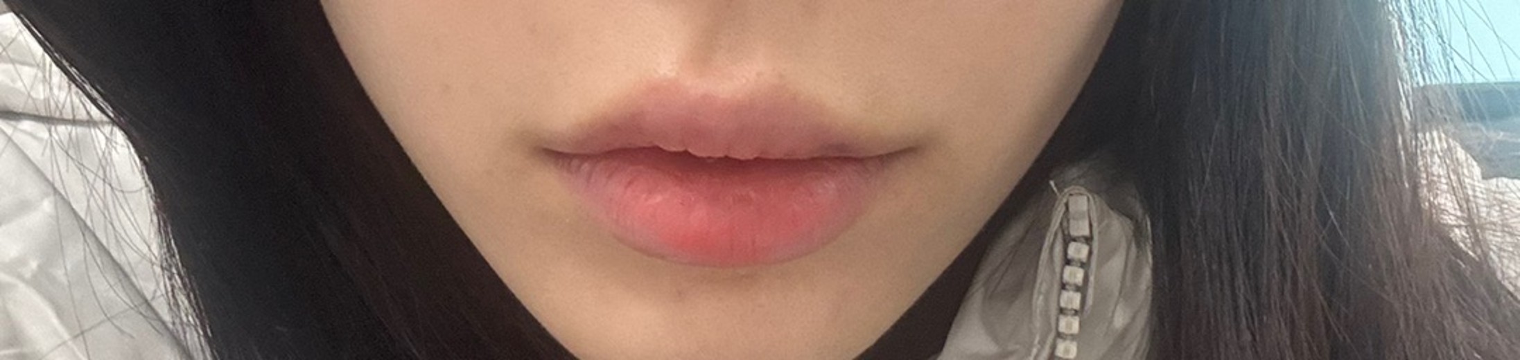 after photo: 입꼬리성형