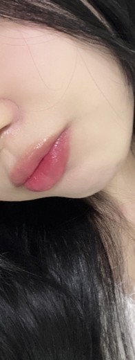 after photo: 입꼬리필러, 입술필러