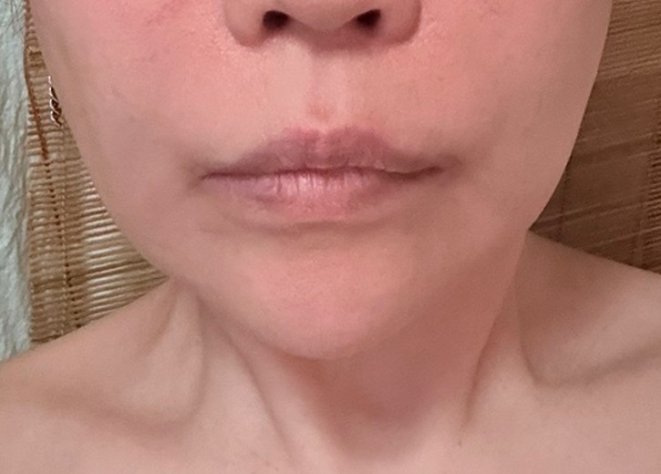 after photo: 脂肪溶解注射(顔)