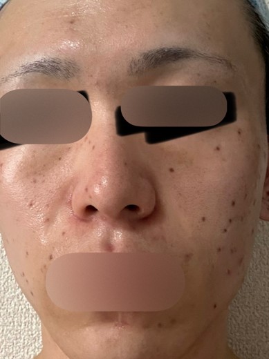 after photo: ピコスポット