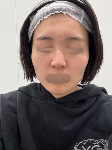 before photo: IPL(光/フォト治療), ピーリング, エレクトロポレーション