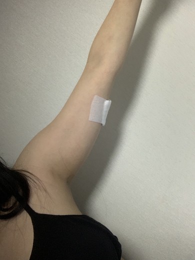 after photo: 팔지방분해주사