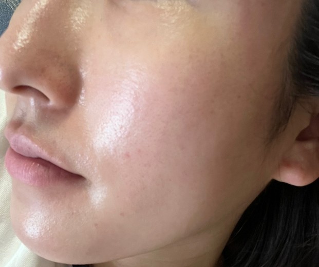 after photo: エレクトロポレーション, ルメッカ