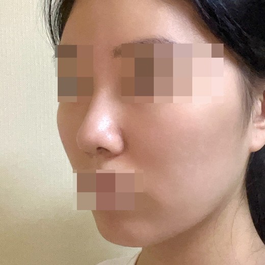 after photo: 코끝(자가연골)