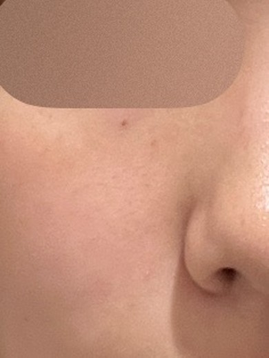 before photo: CO2レーザー, ほくろ除去(レーザー)