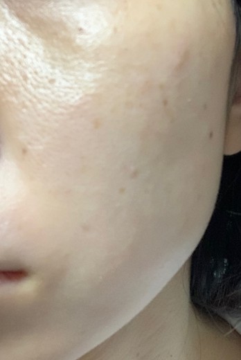 after photo: エレクトロポレーション, ルメッカ
